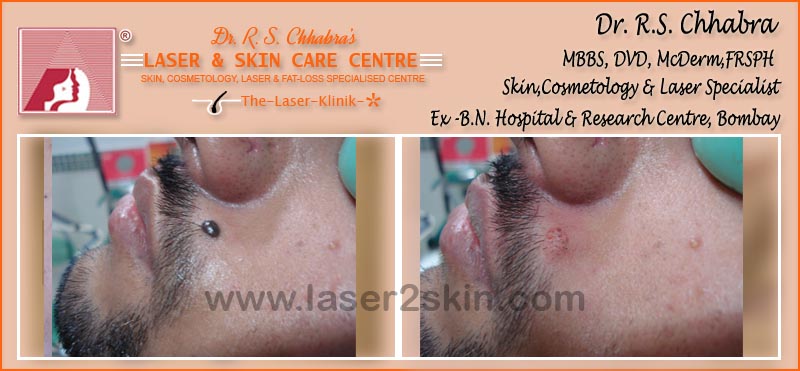 Warts, Moles, Corns, Freckles Treatment With Radio-Freq. Cauterisation by Dr R.S. Chhbara