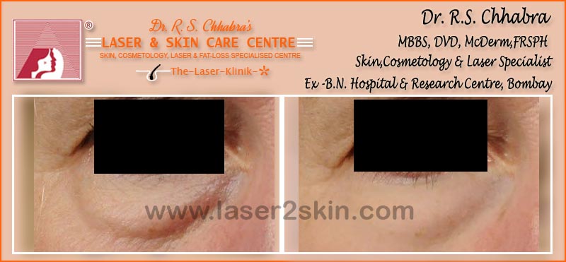 Puffy Eyes treatment With Thermo-Cav Lipo Laser Therapy by Dr R.S. Chhbara