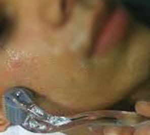 Acne Mars/Pores Acne Mars/Pores