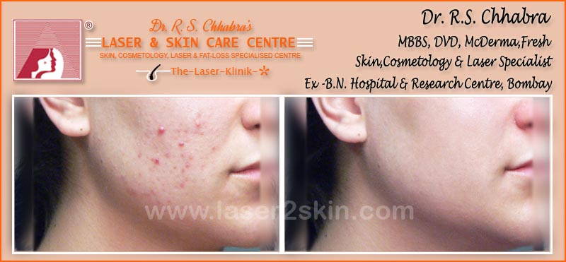 Acne treatment by Dr R.S. Chhbara with laser Acne treatment by Dr R.S. Chhbara with IPL & E-Light laser