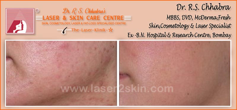 Acne treatment by Dr R.S. Chhbara with IPL & E-Light laser Acne treatment by Dr R.S. Chhbara with IPL & E-Light laser