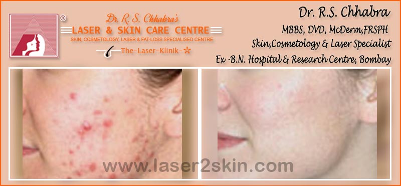 Acne Marks Pores with Microdermabrasion & Derma-Roller by Dr R.S. Chhbara Acne Marks Pores with Microdermabrasion by Dr R.S. Chhbara