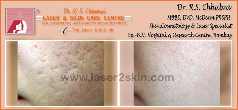 Acne Marks Pores with Microdermabrasion & Derma-Roller by Dr R.S. Chhbara Acne Marks Pores with Microdermabrasion by Dr R.S. Chhbara