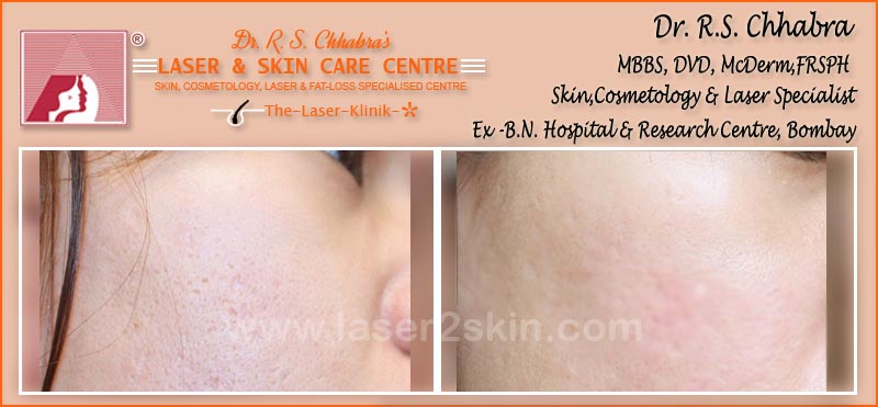 Acne Scars Pits by Dr R.S. Chhbara