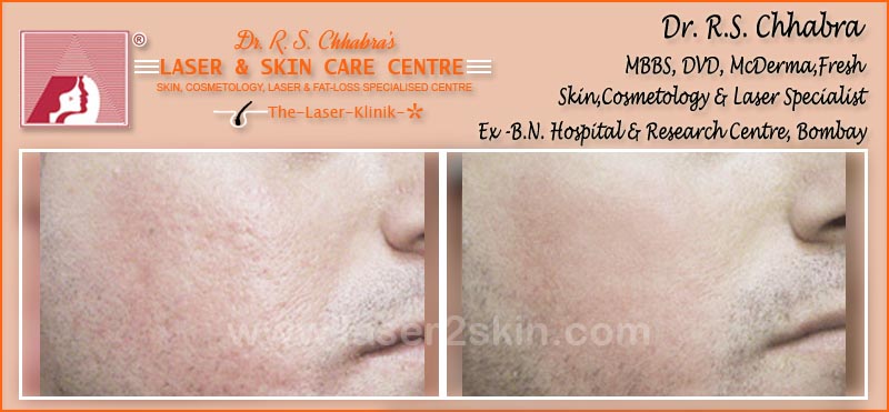 Acne Scars Pits by Dr R.S. Chhbara