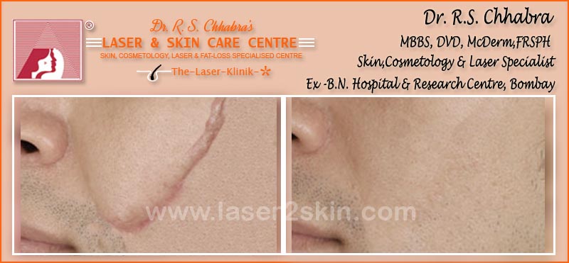 Surgical Scars With CO2 by Dr R.S. Chhbara Surgical Scars With CO2 by Dr R.S. Chhbara