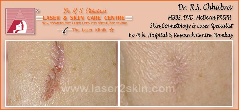 Surgical Scars With CO2urn Marks With CO2 by Dr R.S. Chhbara Surgical Scars With CO2 by Dr R.S. Chhbara
