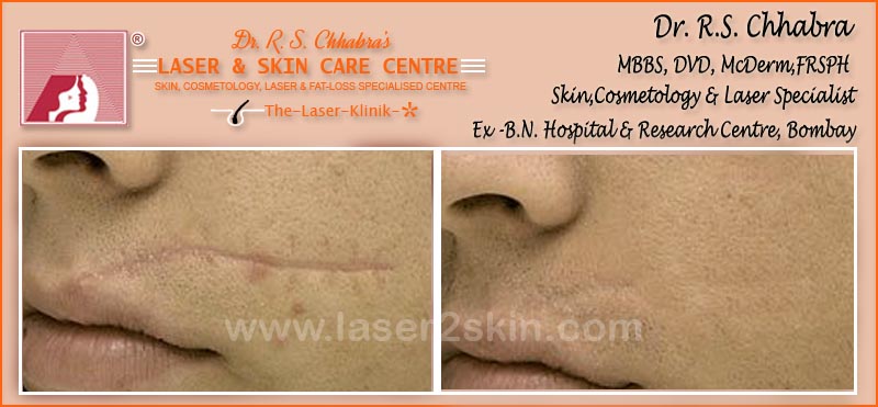 Trauma scars With CO2 by Dr R.S. Chhbara