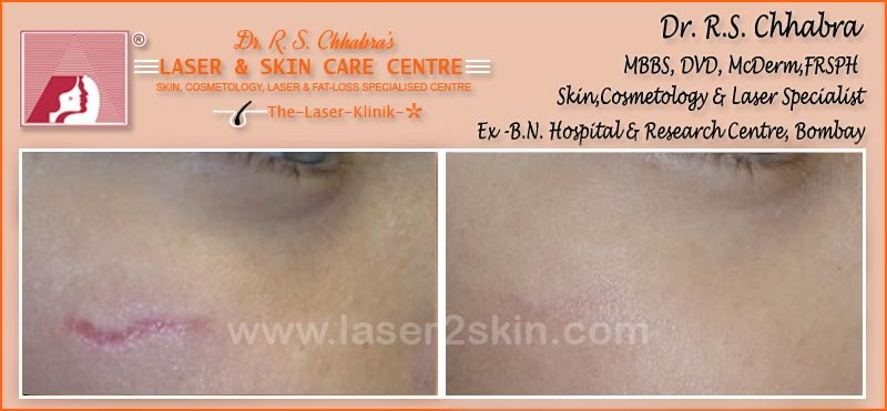 Trauma scars With CO2 by Dr R.S. Chhbara