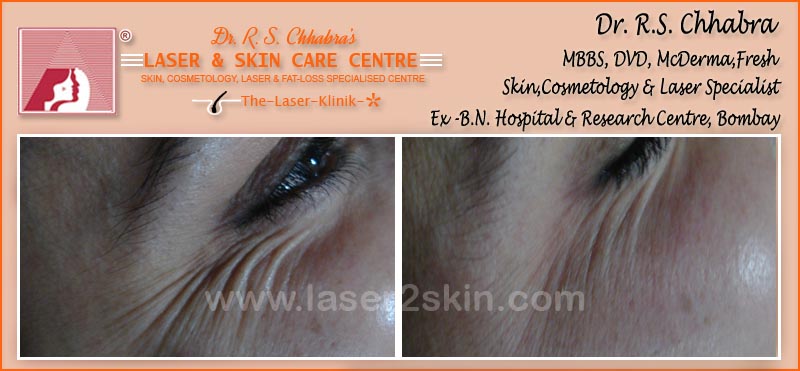 Wrinkles Reduction With Thermo-Cav Lipo Laser Therapy by Dr R.S. Chhbara Wrinkles Reduction With Thermo-Cav Lipo Laser Therapy by Dr R.S. Chhbara