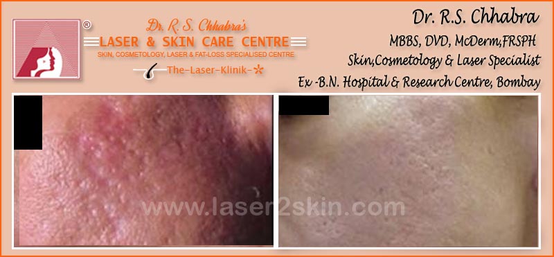 Acne scars treatment by Dr R.S. Chhbara with IPL & E-Light laser Acne Scars treatment by Dr R.S. Chhbara with IPL & E-Light laser