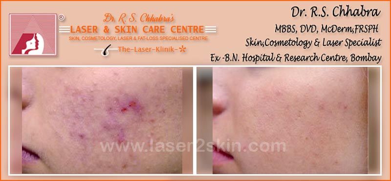 Acne scars treatment by Dr R.S. Chhbara with laser Acne Scars treatment by Dr R.S. Chhbara with laser