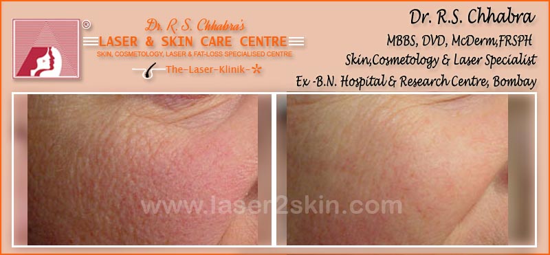 Age & Sun-Spots treatment by Dr R.S. Chhbara with IPL & E-Light laser