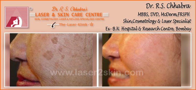 Age & Sun-Spots treatment by Dr R.S. Chhbara with IPL & E-Light laser Age & Sun-Spots treatment by Dr R.S. Chhbara with IPL & E-Light laser