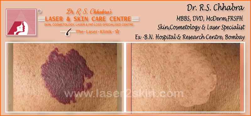 Birth Marks Removal With Q-Switch Laser by Dr R.S. Chhbara Birth Marks Removal With Q-Switch Laser by Dr R.S. Chhbara