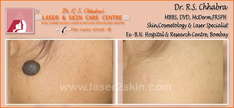 Birth Marks Removal With Q-Switch Laser by Dr R.S. Chhbara Birth Marks Removal With Q-Switch Laser by Dr R.S. Chhbara