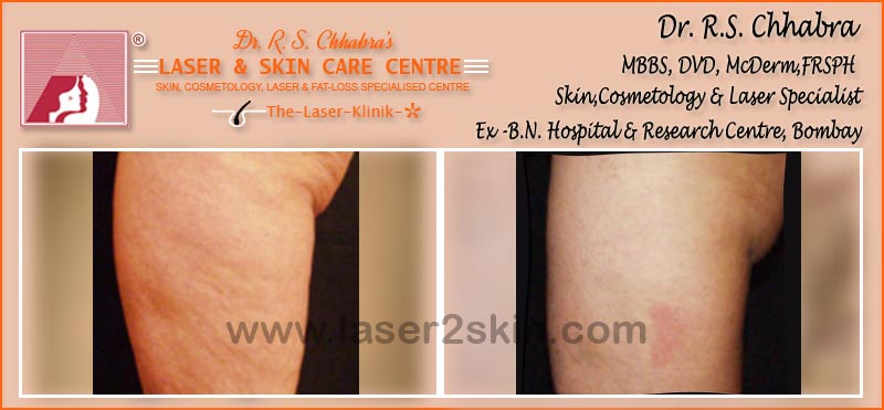 Body Toning With Fat Loss Laser Therapy by Dr R.S. Chhbara Body Toning With Fat Loss Laser Therapy by Dr R.S. Chhbara