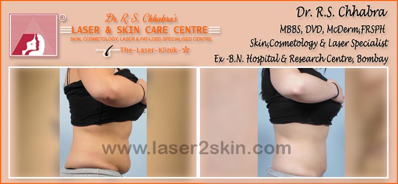 Body Toning With Fat Loss Laser Therapy by Dr R.S. Chhbara