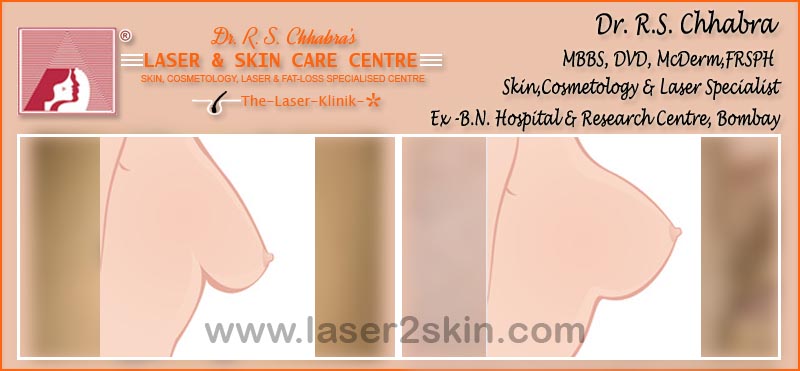 Face & Breast Firming Non-Surgical by Dr R.S. Chhbara Face & Breast Firming Non-Surgical by Dr R.S. Chhbara