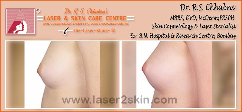 Face & Breast Firming Non-Surgical by Dr R.S. Chhbara Face & Breast Firming Non-Surgical by Dr R.S. Chhbara