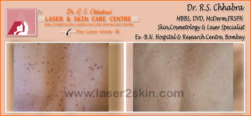 Warts, Moles, Corns, Freckles Treatment With Radio-Freq. Cauterisation by Dr R.S. Chhbara