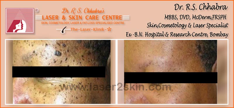 Warts, Moles, Corns, Freckles Treatment With Radio-Freq. Cauterisation by Dr R.S. Chhbara