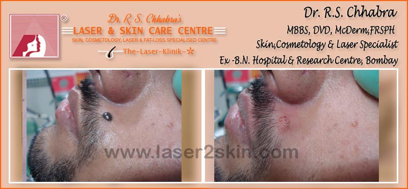 Warts, Moles, Corns, Freckles Treatment With Radio-Freq. Cauterisation by Dr R.S. Chhbara Warts, Moles, Corns, Freckles Treatment With Radio-Freq. Cauterisation by Dr R.S. Chhbara