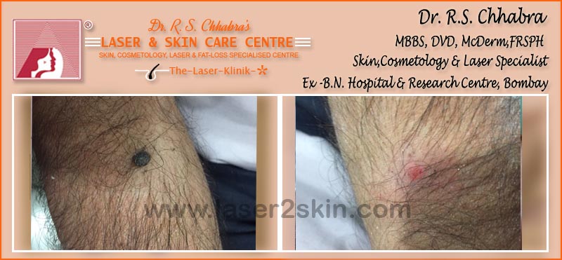 Warts, Moles, Corns, Freckles Treatment With Radio-Freq. Cauterisation by Dr R.S. Chhbara Warts, Moles, Corns, Freckles Treatment With Radio-Freq. Cauterisation by Dr R.S. Chhbara