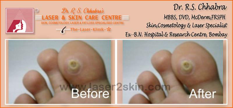 Warts, Moles, Corns, Freckles Treatment With Radio-Freq. Cauterisation by Dr R.S. Chhbara Warts, Moles, Corns, Freckles Treatment With Radio-Freq. Cauterisation by Dr R.S. Chhbara