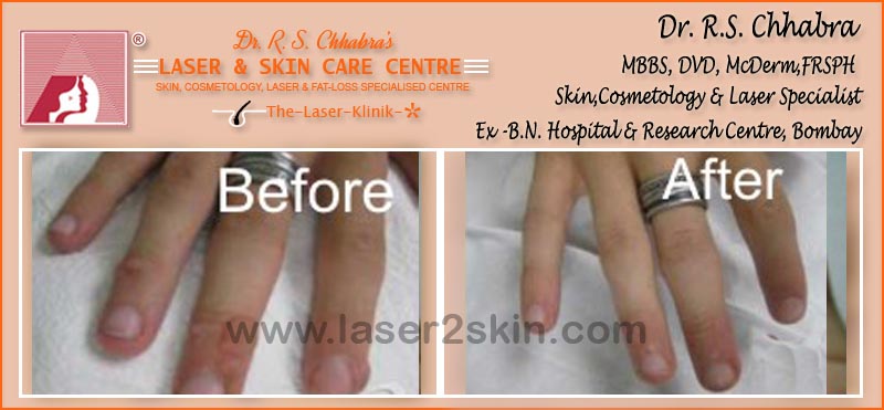 Warts, Moles, Corns, Freckles Treatment With Radio-Freq. Cauterisation by Dr R.S. Chhbara Warts, Moles, Corns, Freckles Treatment With Radio-Freq. Cauterisation by Dr R.S. Chhbara