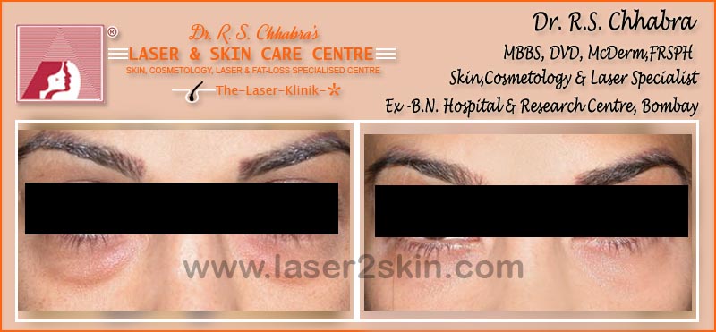 Dark Eye Circles treatment With Ultrasonic & OXY-Therapy by Dr R.S. Chhbara Dark Eye Circles treatment With Ultrasonic & OXY-Therapy by Dr R.S. Chhbara