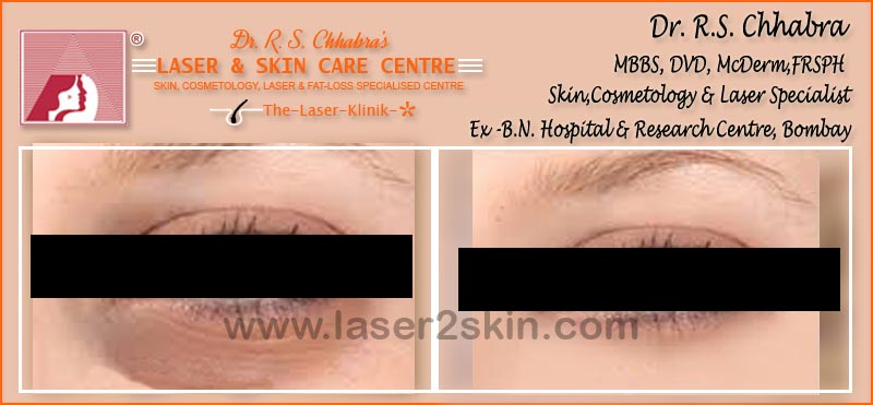 Dark Eye Circles treatment With Ultrasonic & OXY-Therapy by Dr R.S. Chhbara Dark Eye Circles treatment With Ultrasonic & OXY-Therapy by Dr R.S. Chhbara