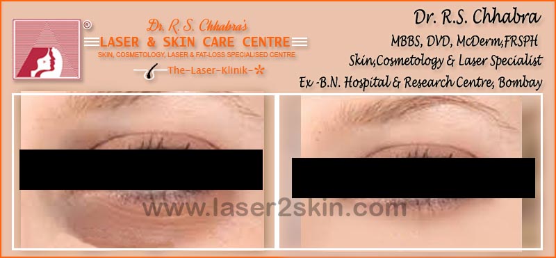 Dark Eye Circles treatment With Ultrasonic & OXY-Therapy by Dr R.S. Chhbara