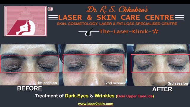 Dark Eye Removal With Q-Switch Laser by Dr R.S. Chhbara Dark Eye Removal With Q-Switch Laser by Dr R.S. Chhbara