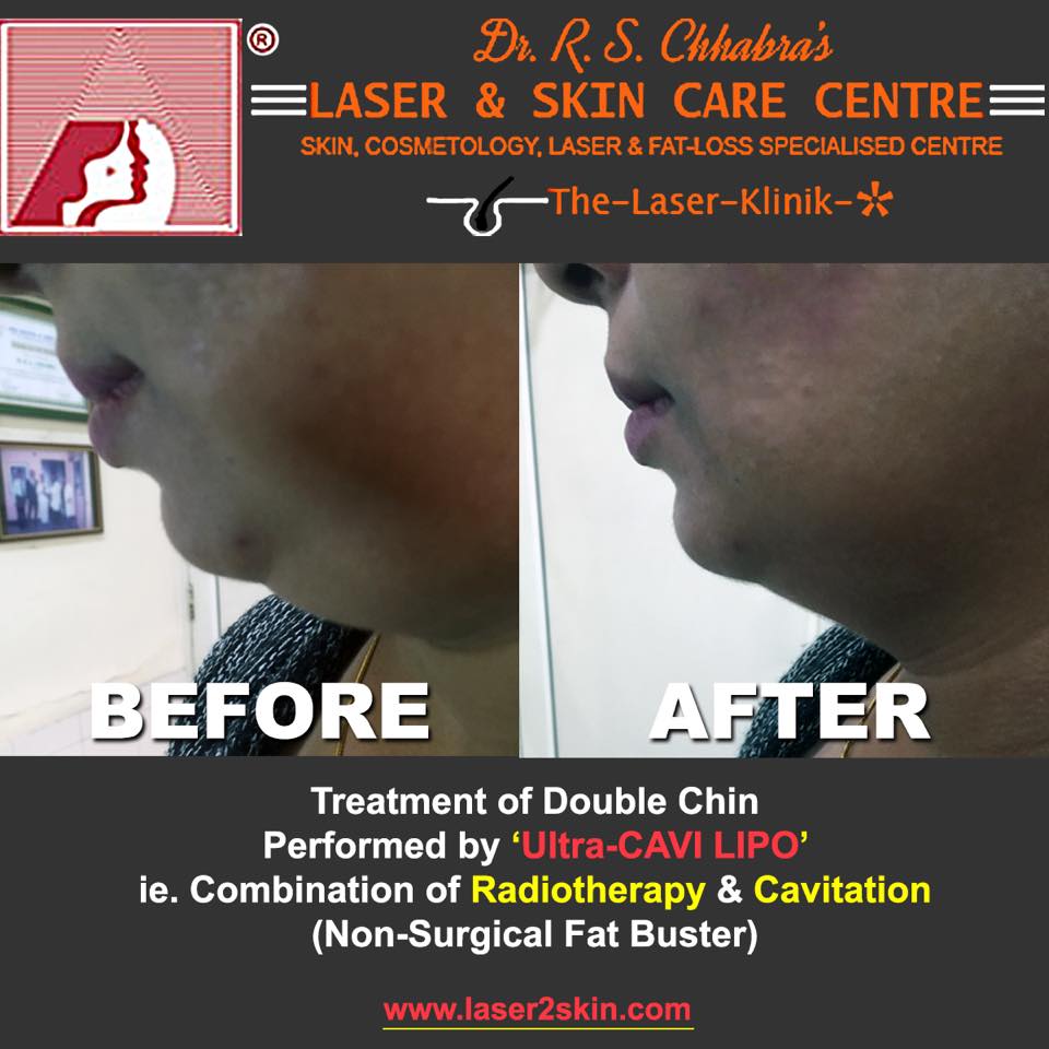 Double Chin Treatment With Thermo-Cav Lipo Laser Therapy by Dr R.S. Chhbara Double Chin Treatment With Thermo-Cav Lipo Laser Therapy by Dr R.S. Chhbara