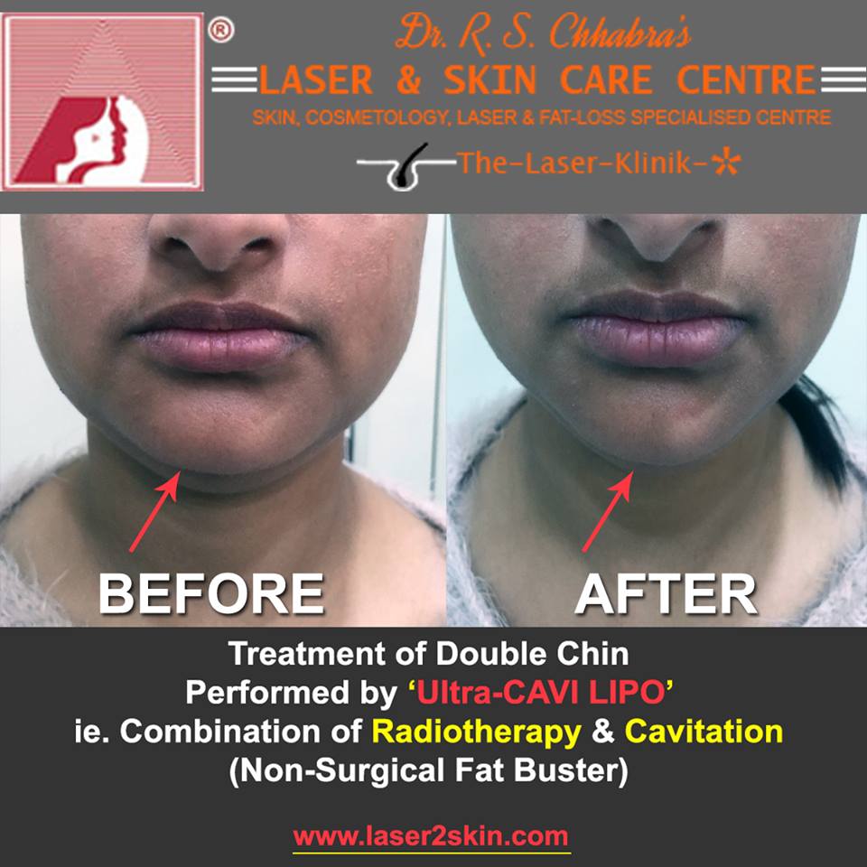 Double Chin Treatment With Thermo-Cav Lipo Laser Therapy by Dr R.S. Chhbara Double Chin Treatment With Thermo-Cav Lipo Laser Therapy by Dr R.S. Chhbara