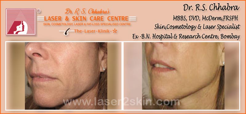 Face & Breast Firming Non-Surgical by Dr R.S. Chhbara Face & Breast Firming Non-Surgical by Dr R.S. Chhbara