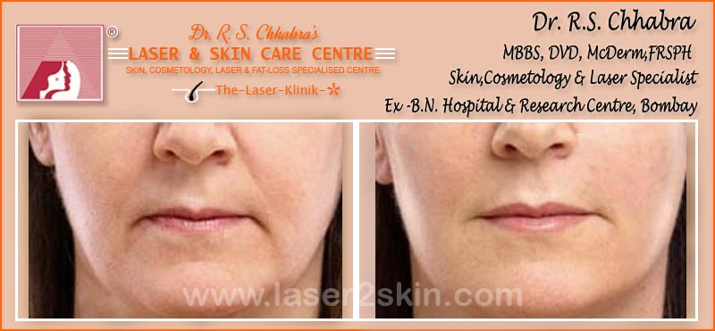 Face & Breast Firming Non-Surgical by Dr R.S. Chhbara Face & Breast Firming Non-Surgical by Dr R.S. Chhbara