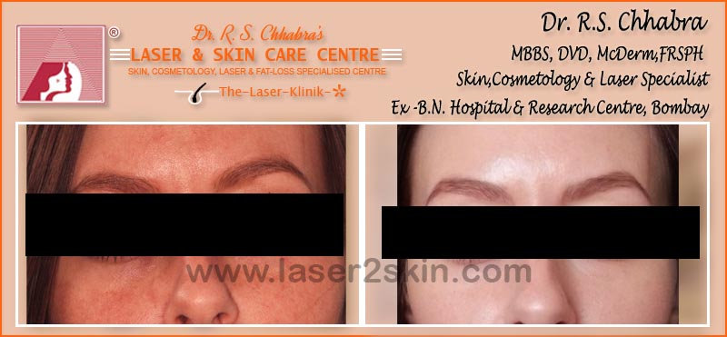 Face & Neck Tanning With Ultrasonic & OXY-Therapy by Dr R.S. Chhbara Face & Neck Tanning With Ultrasonic & OXY-Therapy by Dr R.S. Chhbara