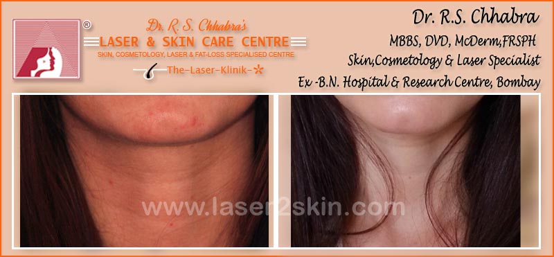 Face & Neck Tanning With Ultrasonic & OXY-Therapy by Dr R.S. Chhbara