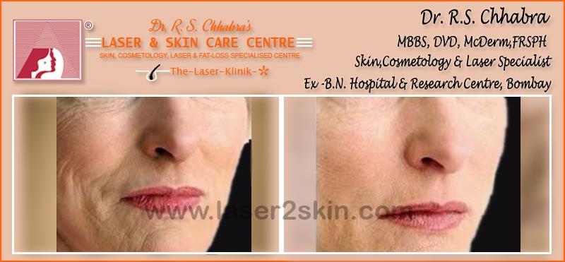 Face Tonning With Thermo-Cav Lipo Laser Therapy by Dr R.S. Chhbara Face Tonning With Thermo-Cav Lipo Laser Therapy by Dr R.S. Chhbara