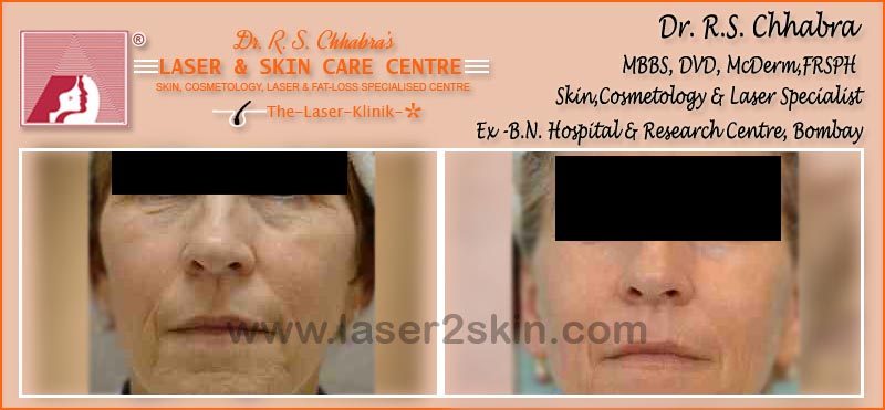Face Tonning With Thermo-Cav Lipo Laser Therapy by Dr R.S. Chhbara Face Tonning With Thermo-Cav Lipo Laser Therapy by Dr R.S. Chhbara