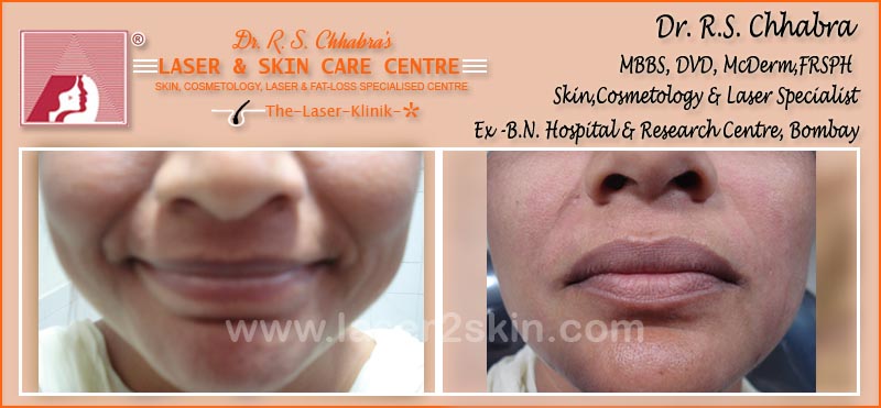Fillers Treatment by Dr R.S. Chhbara Fillers Treatment by Dr R.S. Chhbara