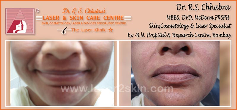 Fillers Treatment by Dr R.S. Chhbara