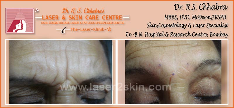 Fillers Treatment by Dr R.S. Chhbara Fillers Treatment by Dr R.S. Chhbara