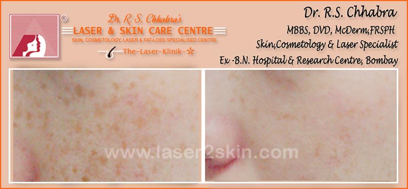 Freckles Removal With Q-Switch Laser by Dr R.S. Chhbara Freckles Removal With Q-Switch Laser by Dr R.S. Chhbara