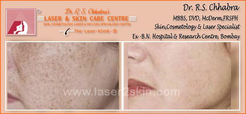 Freckles Removal With Q-Switch Laser by Dr R.S. Chhbara Freckles Removal With Q-Switch Laser by Dr R.S. Chhbara