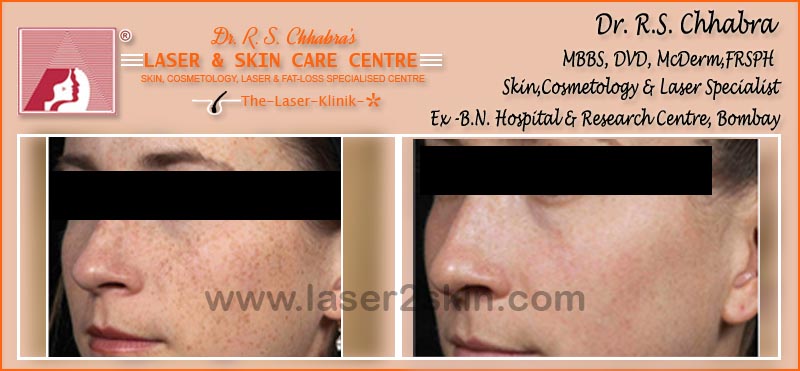 Hyper Pigmentation With Q-Switch Laser by Dr R.S. Chhbara