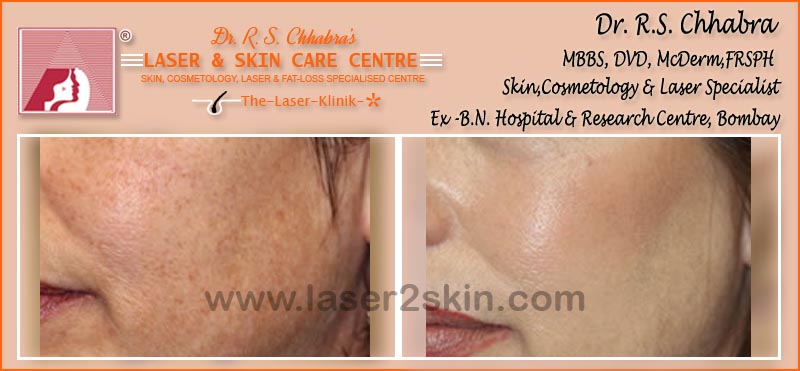 Hyper Pigmentation With Q-Switch Laser by Dr R.S. Chhbara