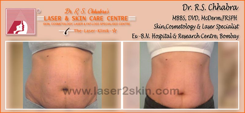 Inch Loss With Fat Loss Laser Therapy by Dr R.S. Chhbara Inch Loss With Fat Loss Laser Therapy by Dr R.S. Chhbara